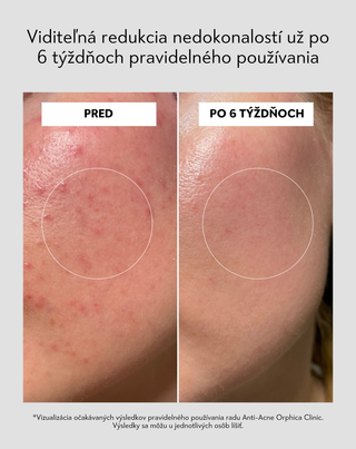Nočné sérum na podporu regenerácie problematickej pleti Anti-Acne Orphica Clinic 50 ml - 6