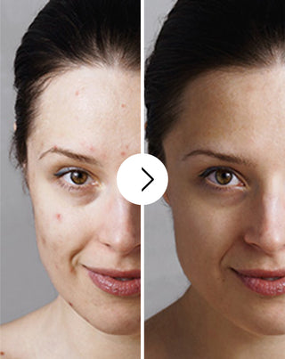 Tabletky na akné, vyrážky a nedokonalosti pleti so zinkom, vitamínmi C, E a B2 Derminax_3 - 3