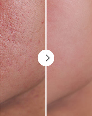 Tabletky na akné, vyrážky a nedokonalosti pleti so zinkom, vitamínmi C, E a B2 Derminax - 6