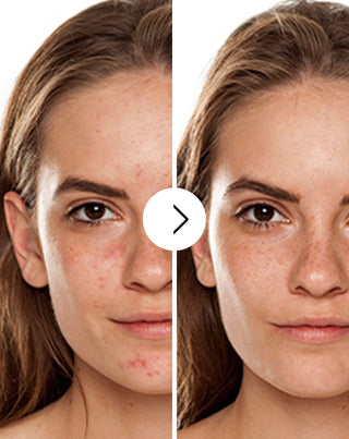 Tabletky na akné, vyrážky a nedokonalosti pleti so zinkom, vitamínmi C, E a B2 Derminax_2 - 2