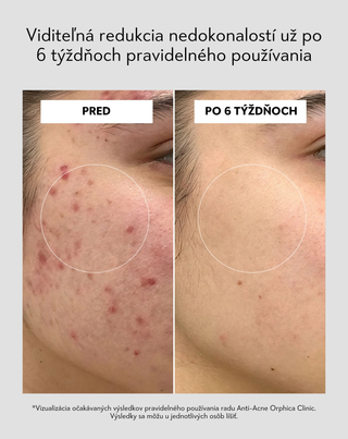Pleťový peeling s niacínamidom, pantenolom, BHA a mikrogranulami Anti-Acne Orphica Clinic 100 ml - 5