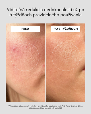 Denný krém proti akné s kyselinou salicylovou a azelaovou Anti-Acne Orphica Clinic 50 ml - 5
