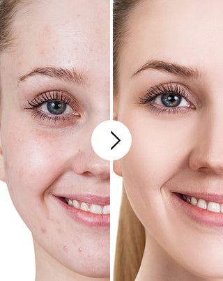 Tabletky na akné, vyrážky a nedokonalosti pleti so zinkom, vitamínmi C, E a B2 Derminax_6 - 5