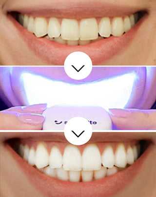 Sada na bielenie zubov s LED lampou a bieliacim gélom Light & Bright Smilebite - 3